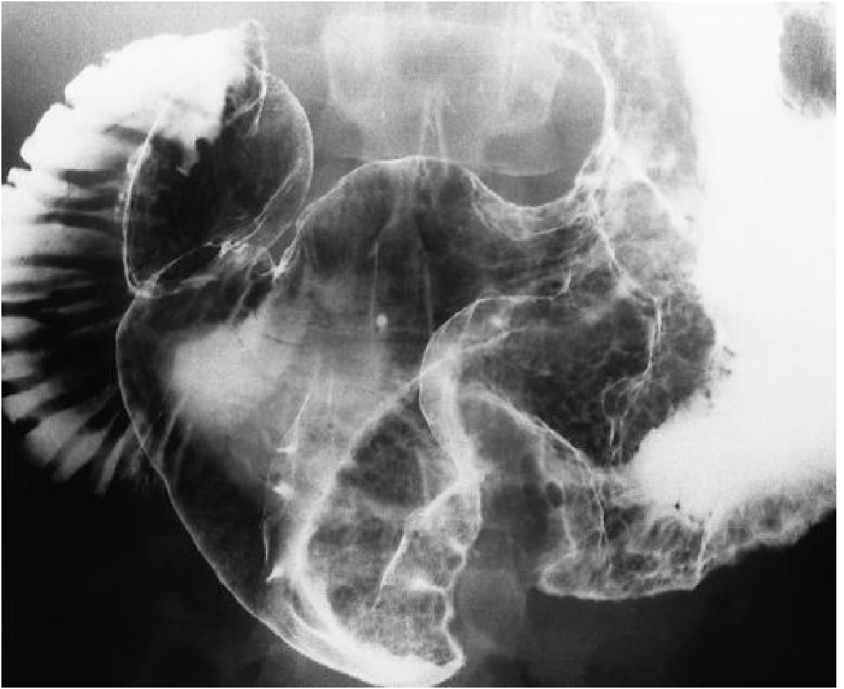 Ménétrier Disease - Barium study showing massively enlarged, lobular, cerebriform folds in the gastric body with antral sparing. The folds remain pliable (distinguishing from malignancy)