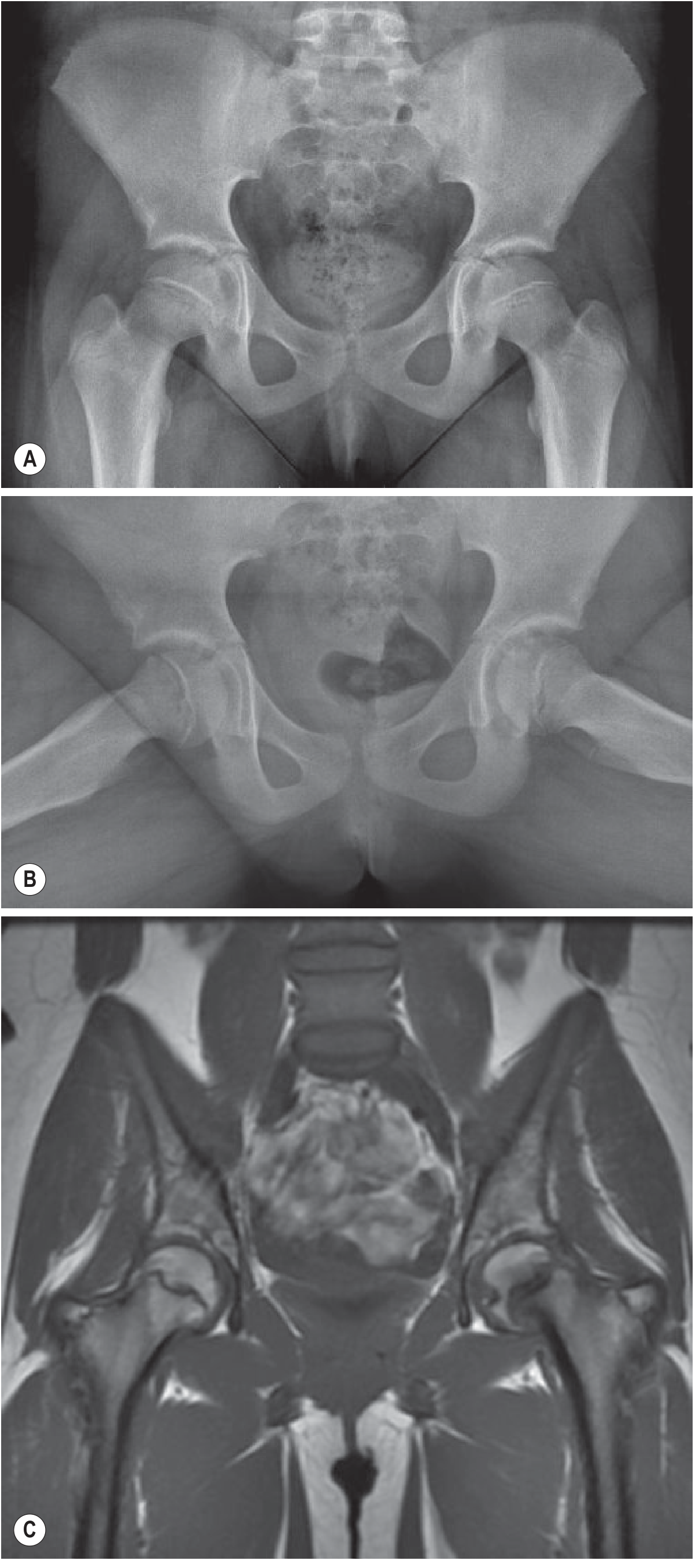 SCFE - AP pelvis (A), frog-leg lateral (B), and MRI (C) showing left-sided slip