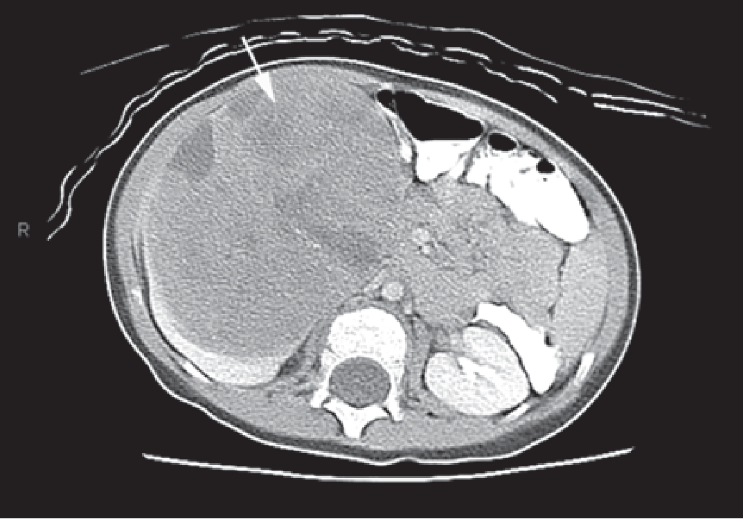 Wilms tumor CT showing IVC claw sign and cavoatrial thrombus