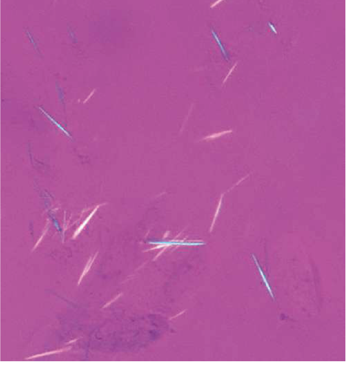 Urate crystals on polarized microscopy