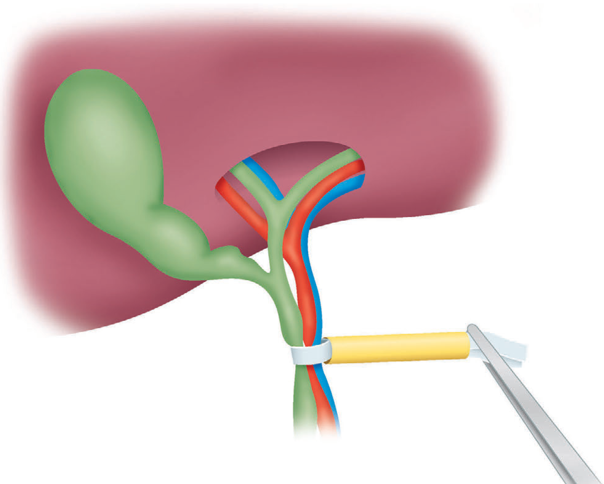 The Pringle manoeuvre - clamp on hepatoduodenal ligament