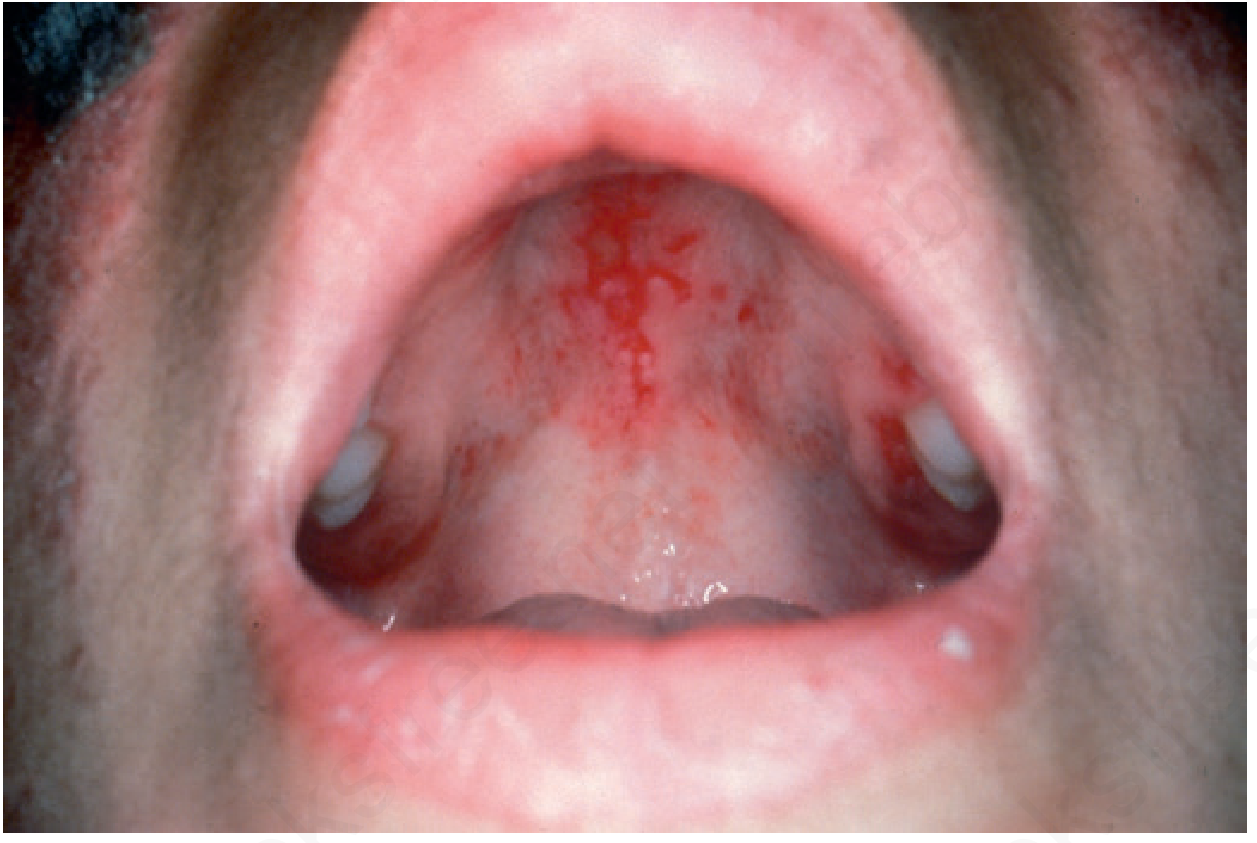 Oral lupus