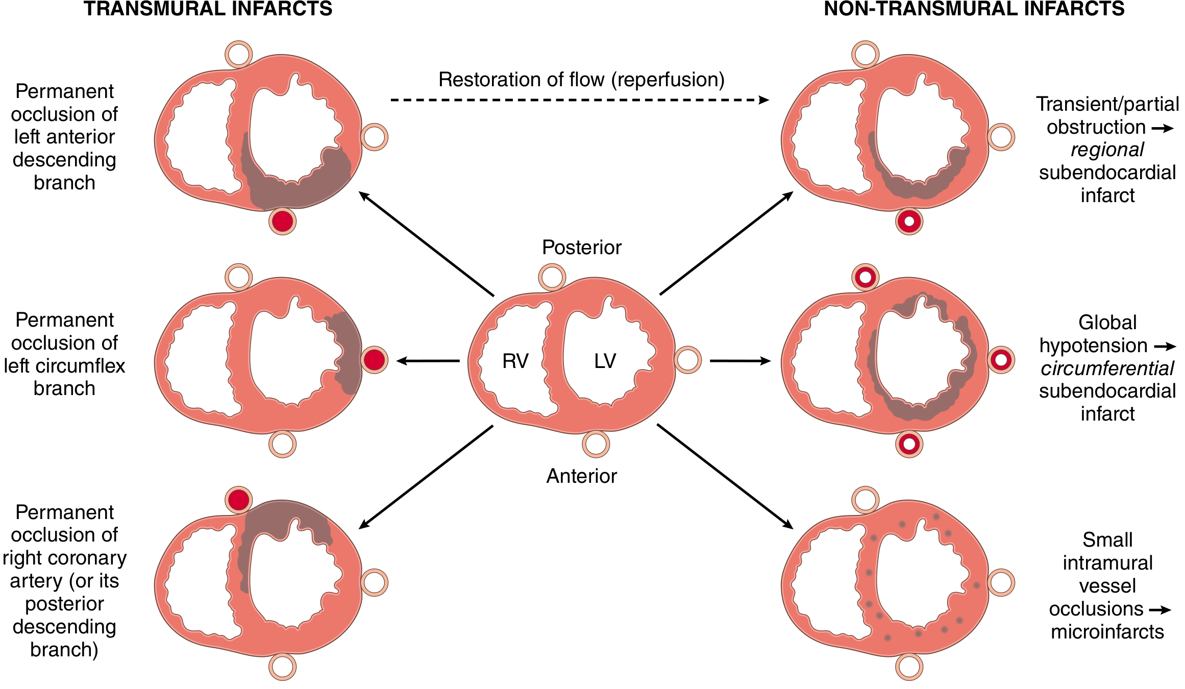 Distribution of transmural vs non-transmural infarcts by vessel