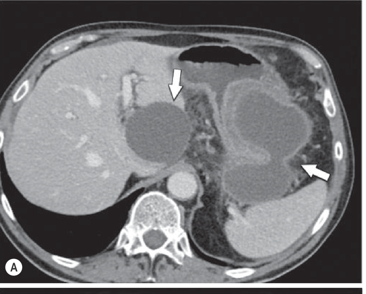 Fig 25.12A - Pseudocyst CT