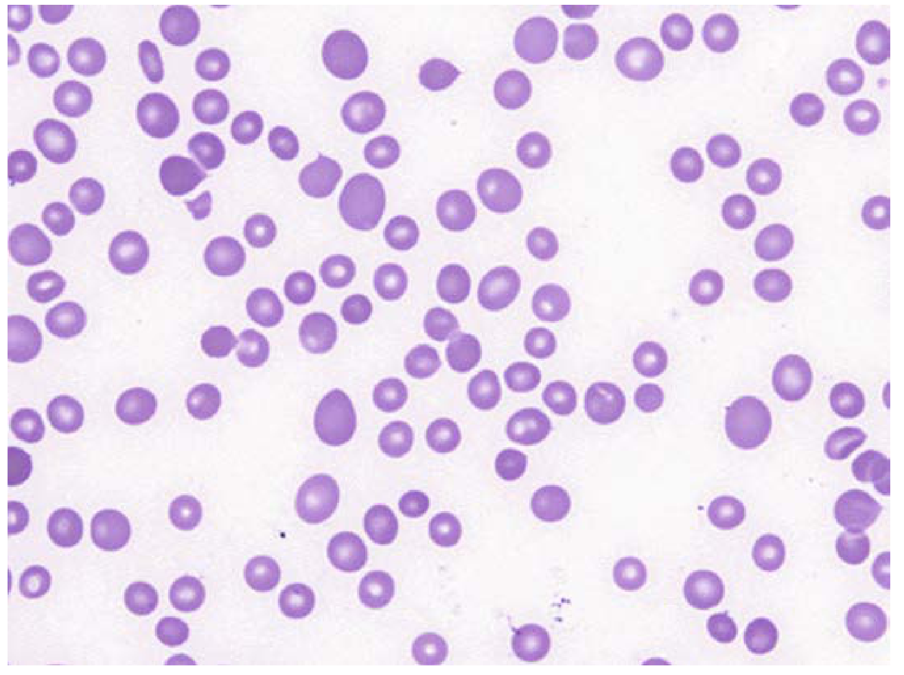 Macrocytes in megaloblastic anemia - large cells staining deeply without central pallor