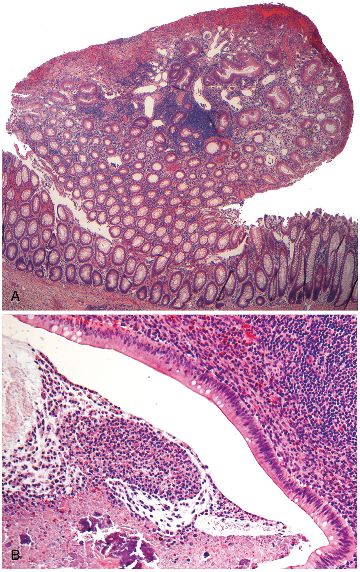 Juvenile polyposis histology: (A) Juvenile polyp with surface erosion and cystically dilated crypts; (B) Inspissated mucus, neutrophils, and inflammatory debris within dilated crypts