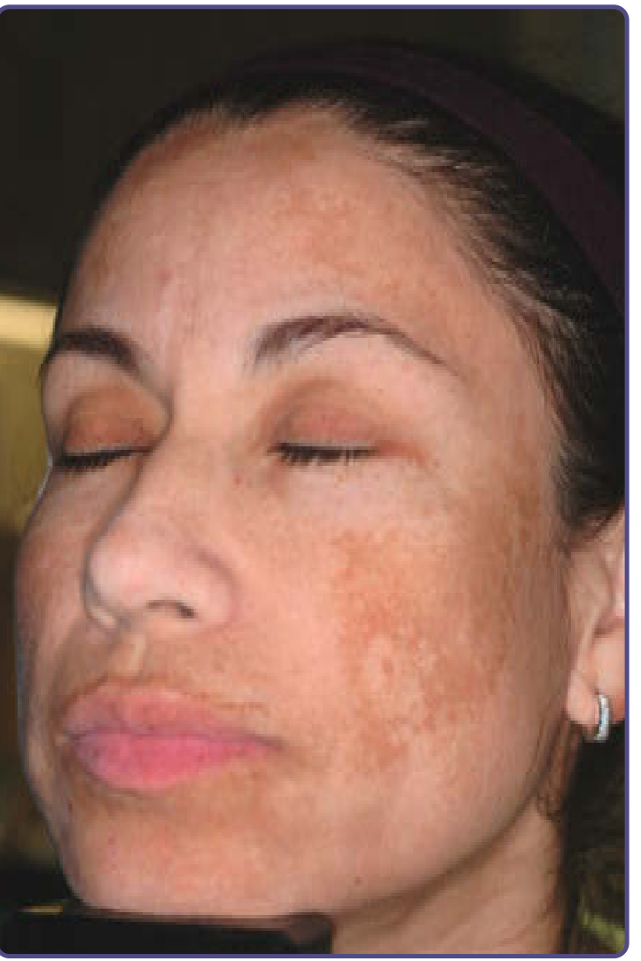 Melasma - malar and centrofacial pattern