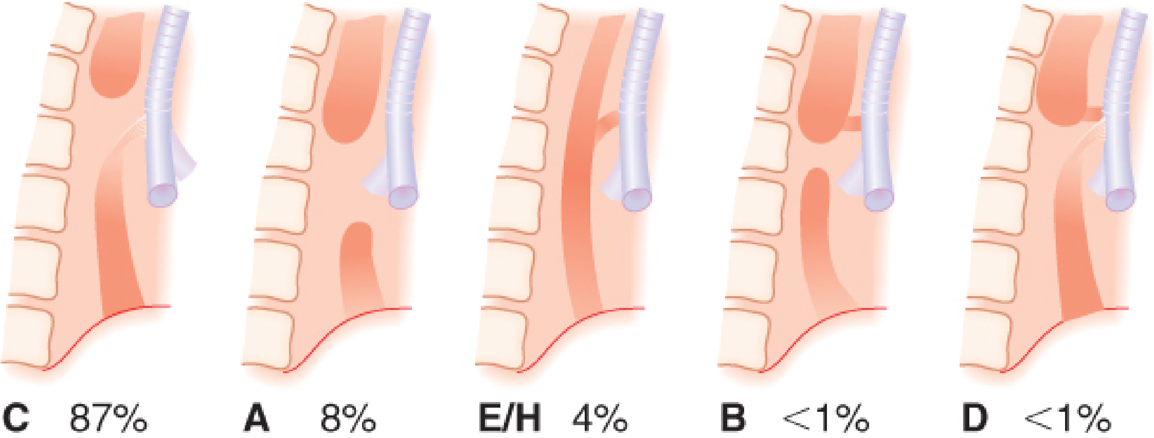 Five most common forms of esophageal atresia and TEF shown in order of frequency - Type C 87%, Type A 8%, Type E/H 4%, Type B <1%, Type D <1%