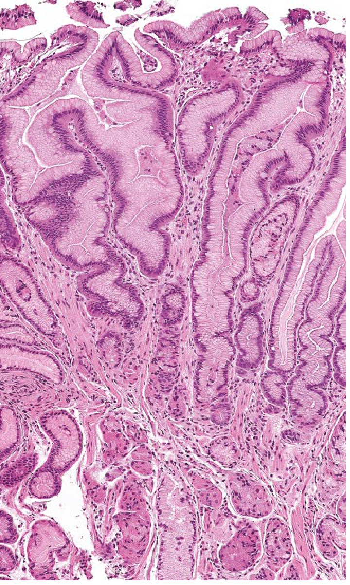 Ménétrier Disease histology - massively expanded foveolar (mucous cell) epithelium with elongated, tortuous, corkscrew-shaped glands and cystic dilation. Parietal and chief cells are markedly reduced