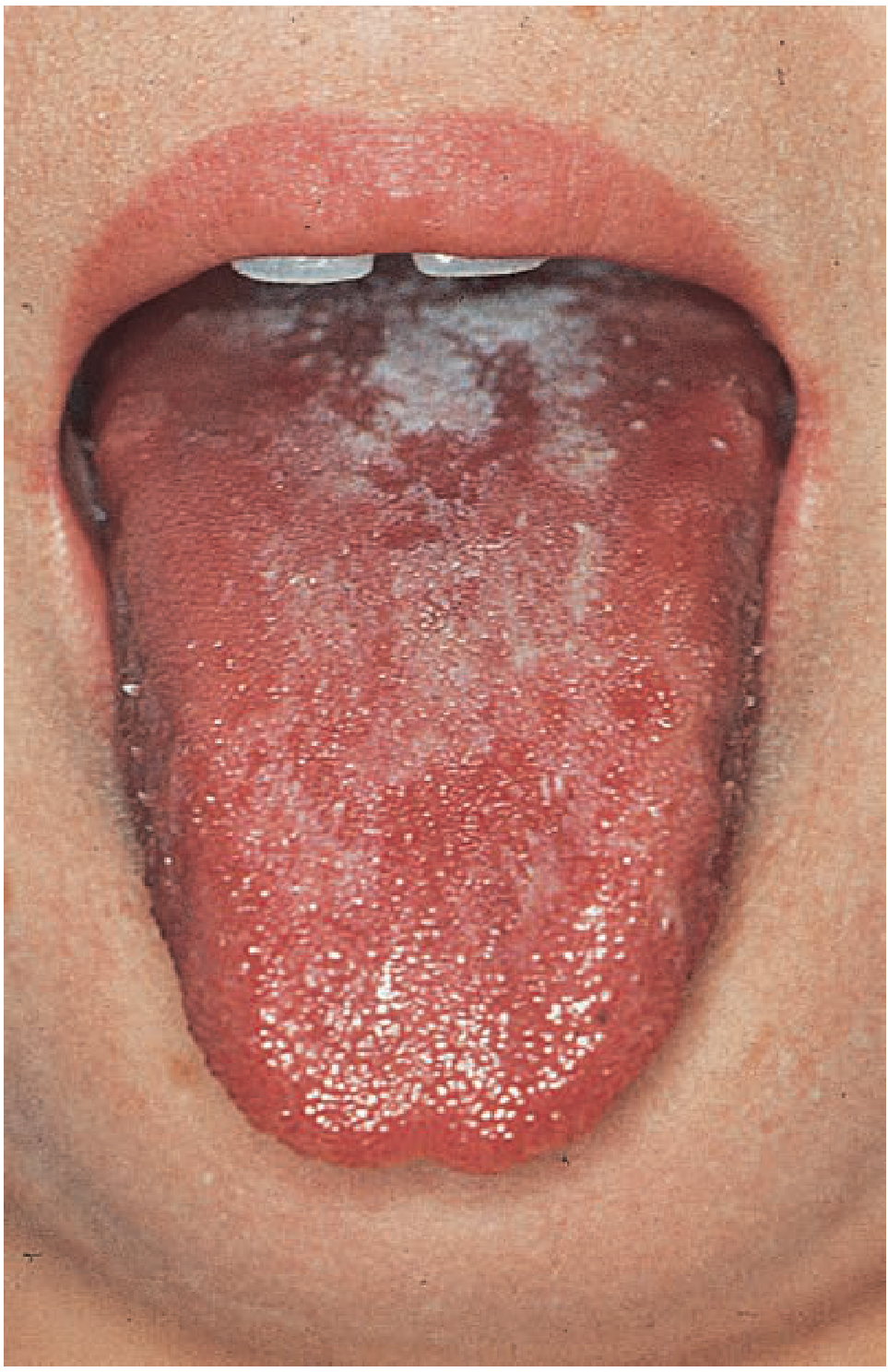 Scarlet fever white and red strawberry tongue