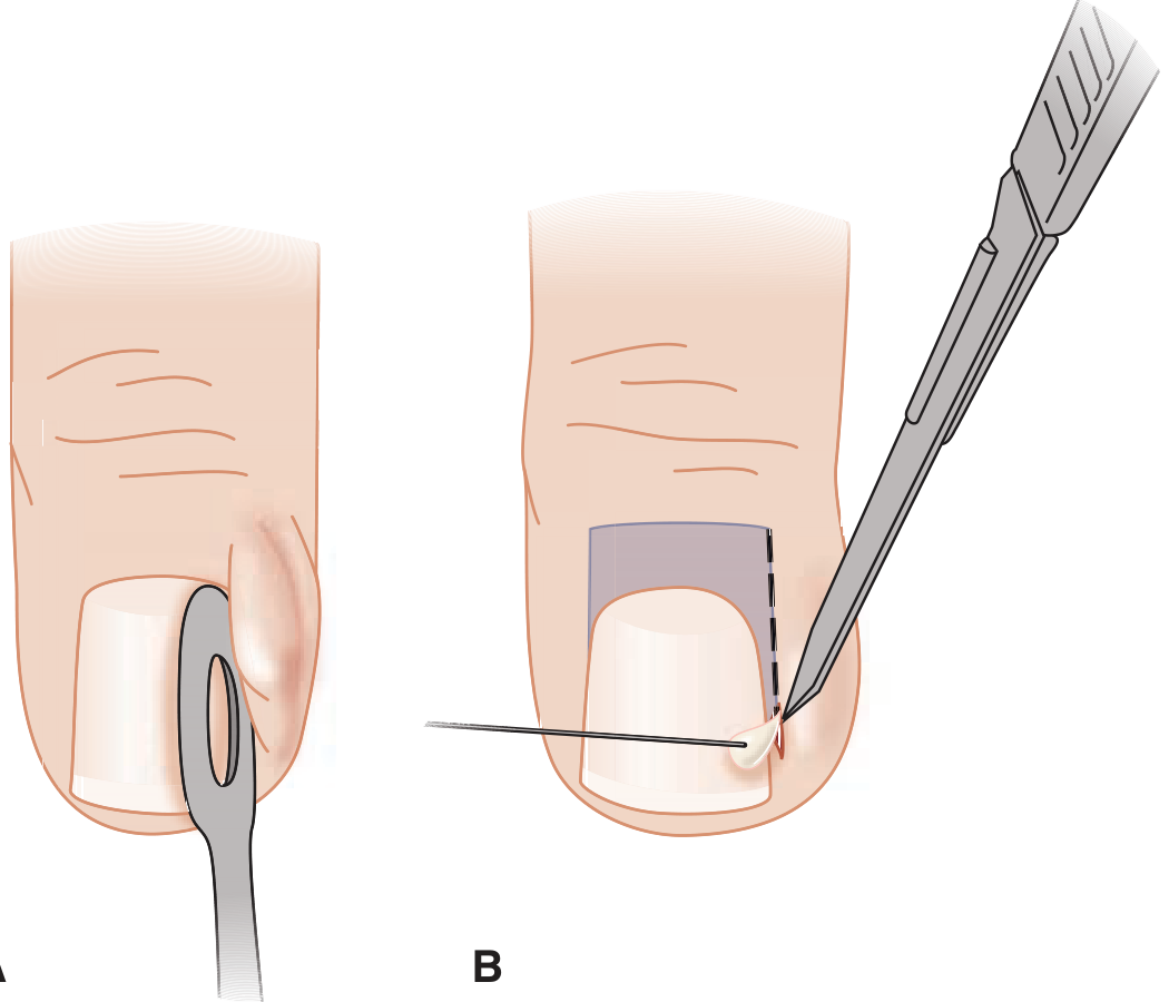 Paronychia drainage technique - A: flat probe elevates the nail fold; B: #11 blade incises directly into the area of greatest fluctuance
