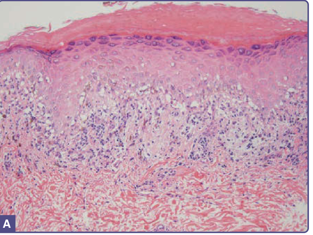 Lichen planus histology showing wedge-shaped hypergranulosis (pop tent sign), sawtooth rete ridges, compact orthohyperkeratosis, and band-like lichenoid infiltrate at the DEJ