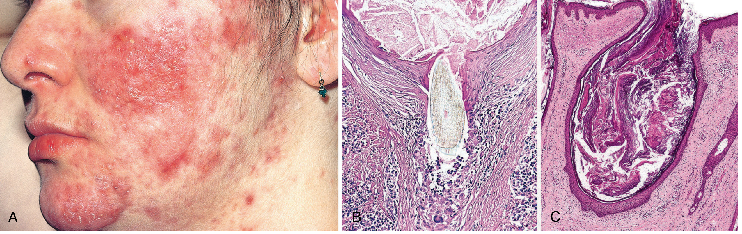 Acne vulgaris clinical photo showing inflammatory papules, pustules, and erythema with histology panels B (ruptured follicle) and C (open comedone)
