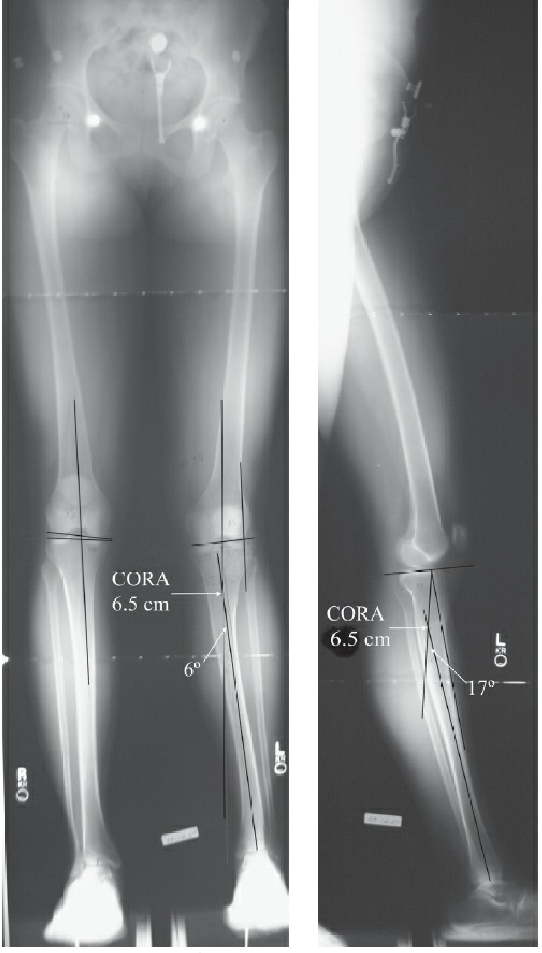 CORA on radiograph - 6° AP and 17° lateral tibial deformity both at CORA 6.5 cm distal to proximal tibial joint orientation line