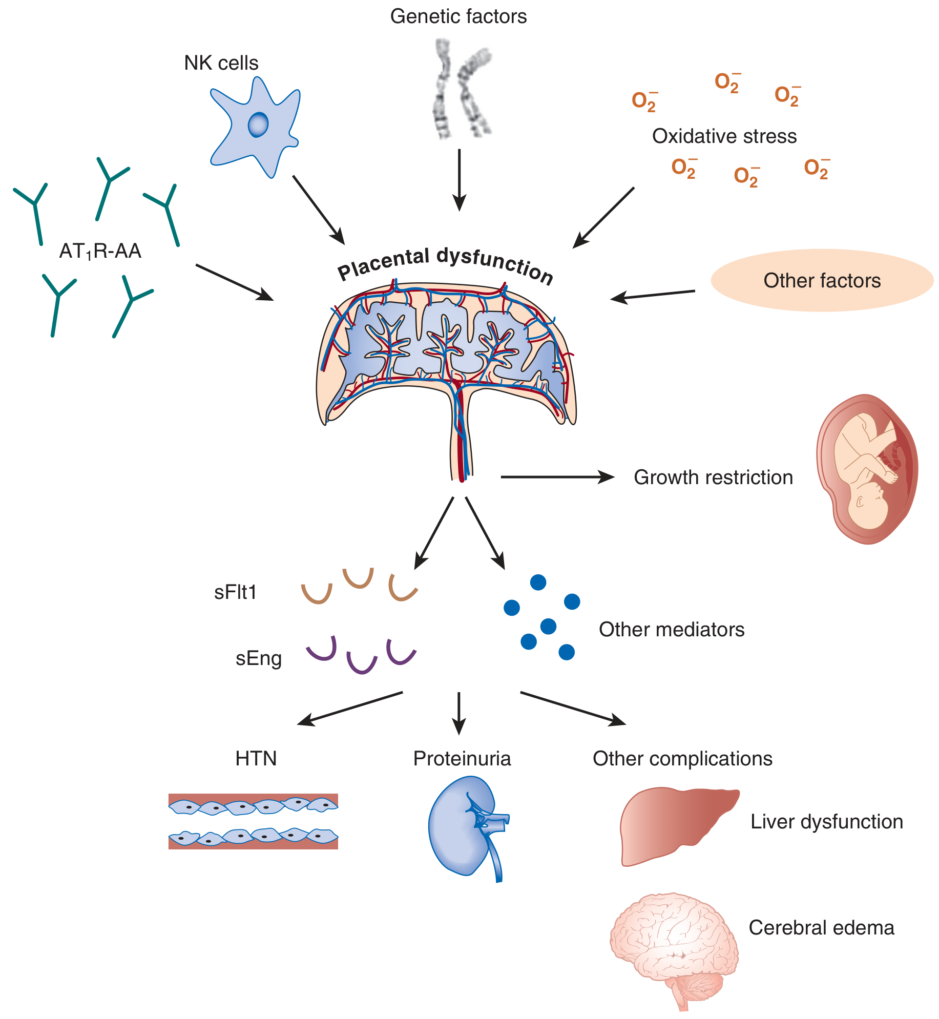 Pathogenesis of preeclampsia - from placental dysfunction to end-organ damage
