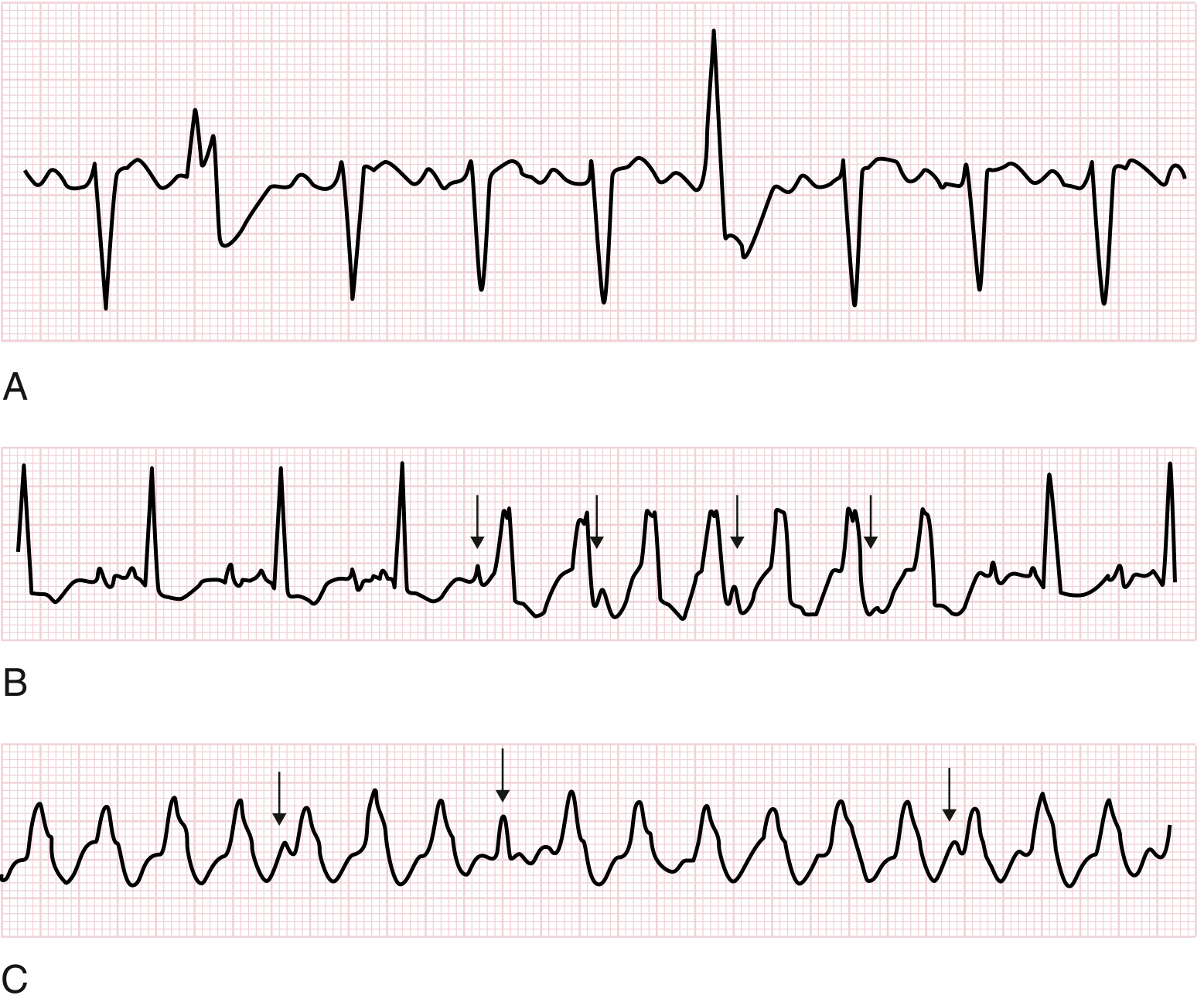 Goldman-Cecil ECG: A=multifocal PVCs; B=nonsustained monomorphic VT with dissociated P waves; C=sustained monomorphic VT with fusion beat at beat 8