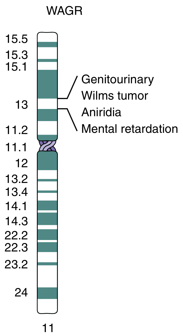 WAGR chromosome 11 deletion diagram