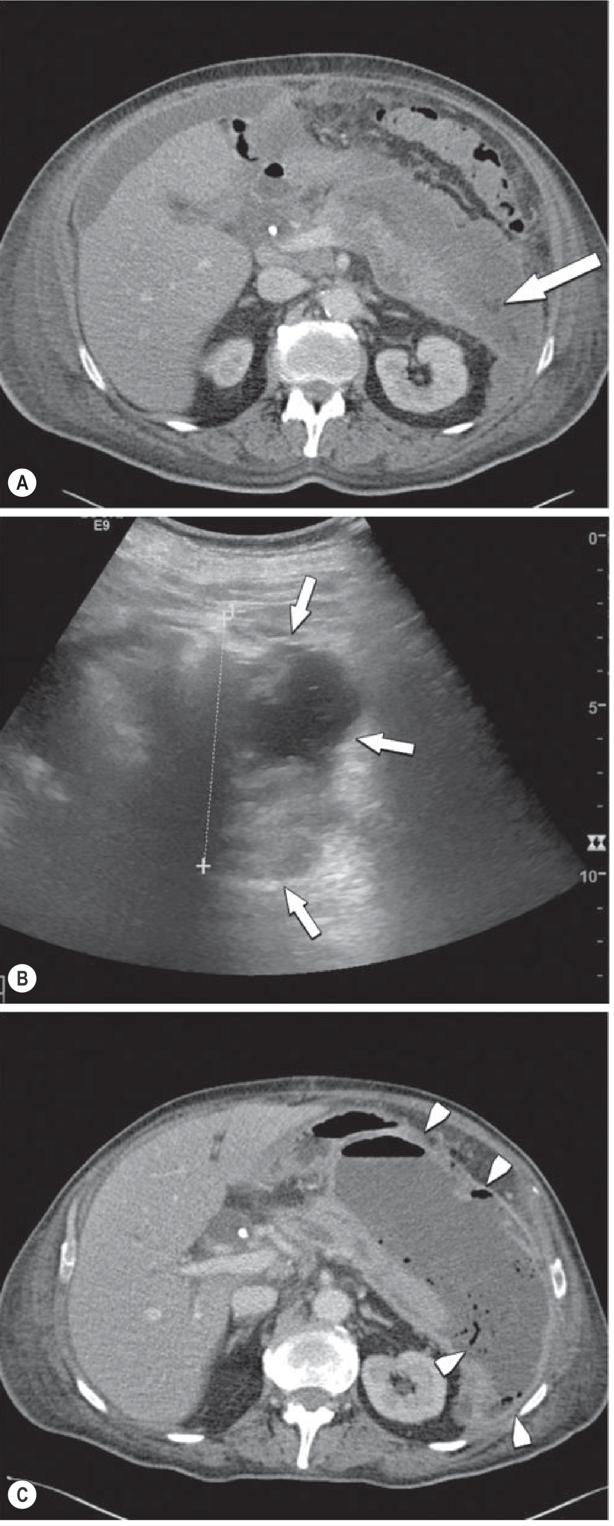 Fig 25.16 - Infected walled-off necrosis
