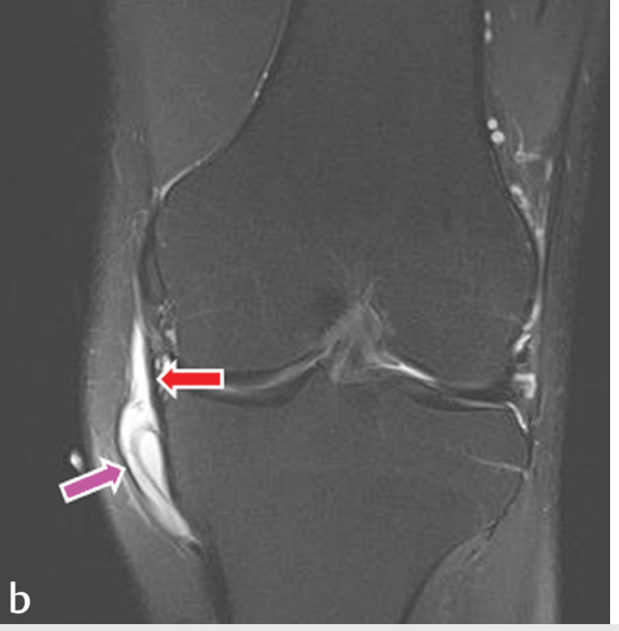 Coronal MRI showing bright fluid pool of pes anserine bursitis below medial joint line