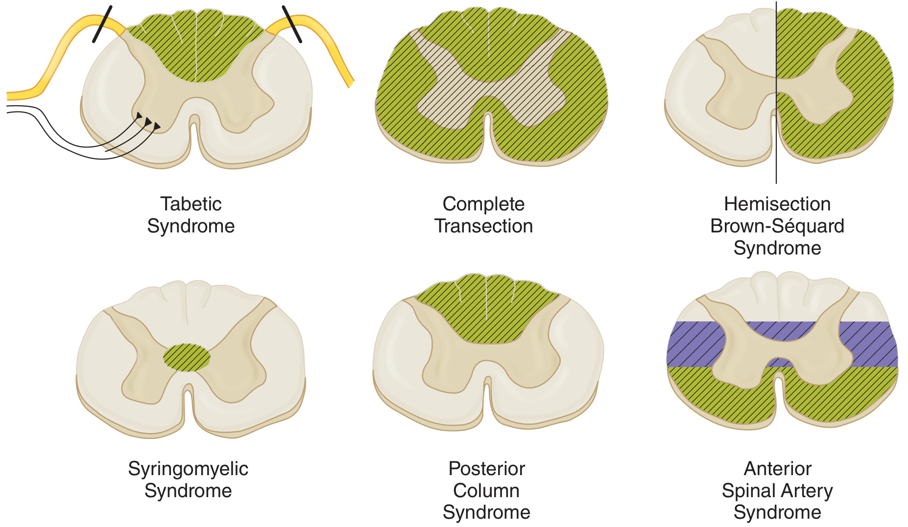 Spinal cord sensory syndromes - cross-sections showing each pattern