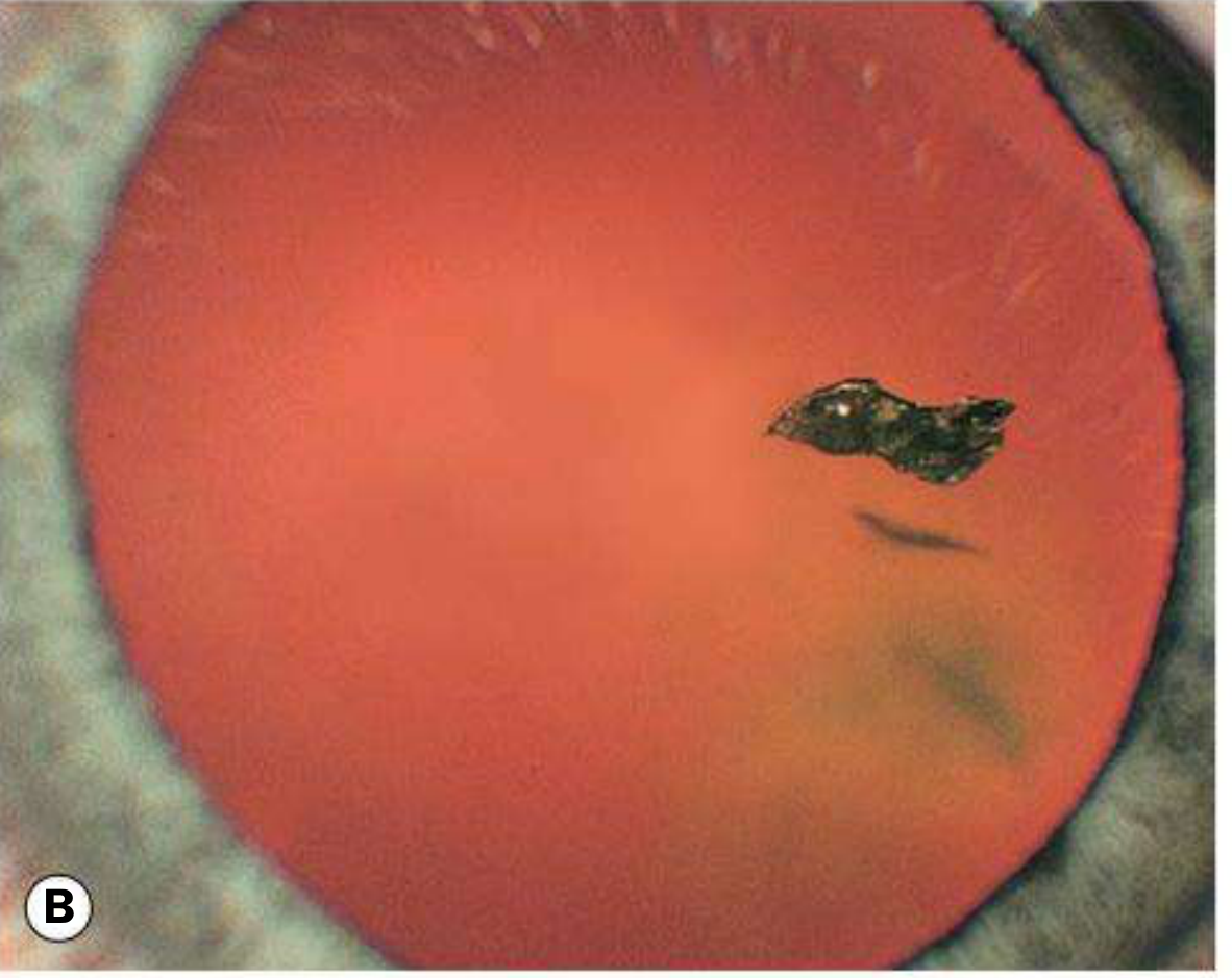 Foreign body in lens/posterior segment with associated vitreous hemorrhage