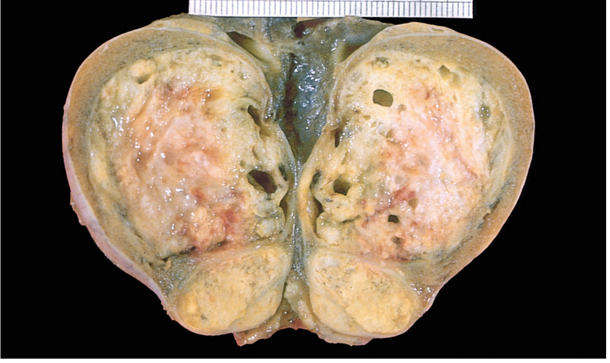 Teratoma of testis - variegated cut surface with cysts
