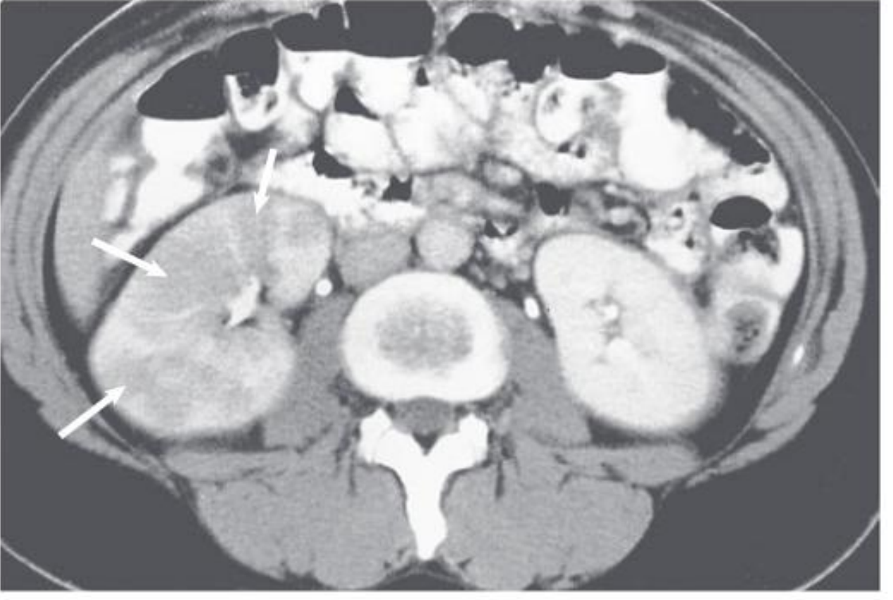 CT scan of acute pyelonephritis showing areas of lower density (arrows) caused by infection and edema in the right kidney