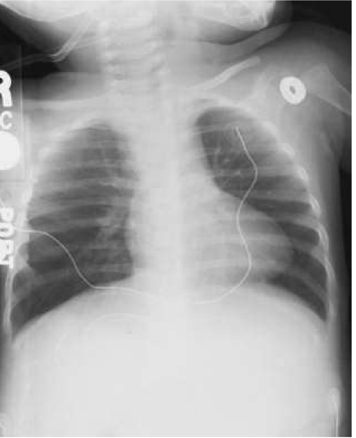Boot-shaped heart of Tetralogy of Fallot - classic chest X-ray