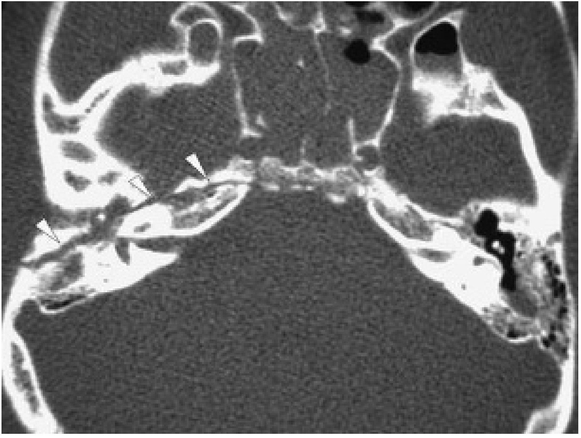 Longitudinal temporal bone fracture CT: fracture line (arrows) passes anterior to the genu of the facial nerve