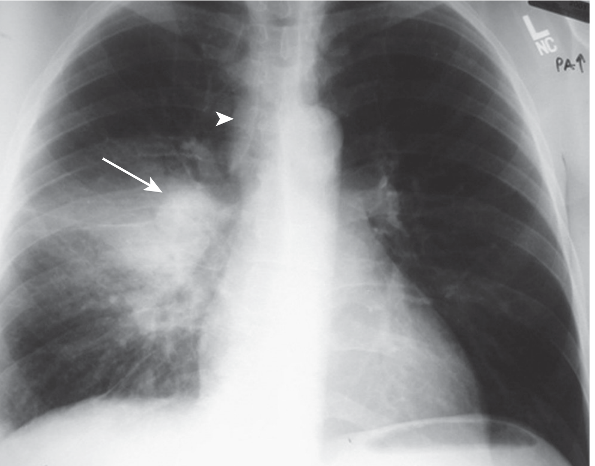 Primary TB - Ghon complex showing lower lobe consolidation with right hilar lymphadenopathy