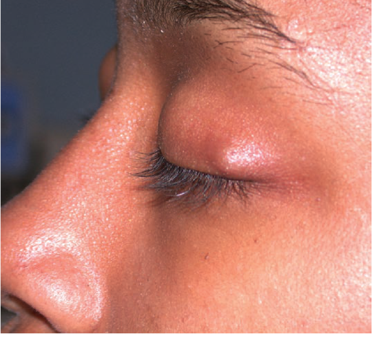 Chalazion - painless eyelid swelling/nodule