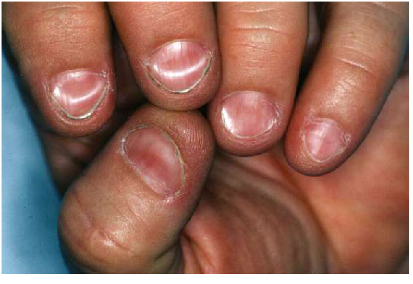 Koilonychia — spooning of nails