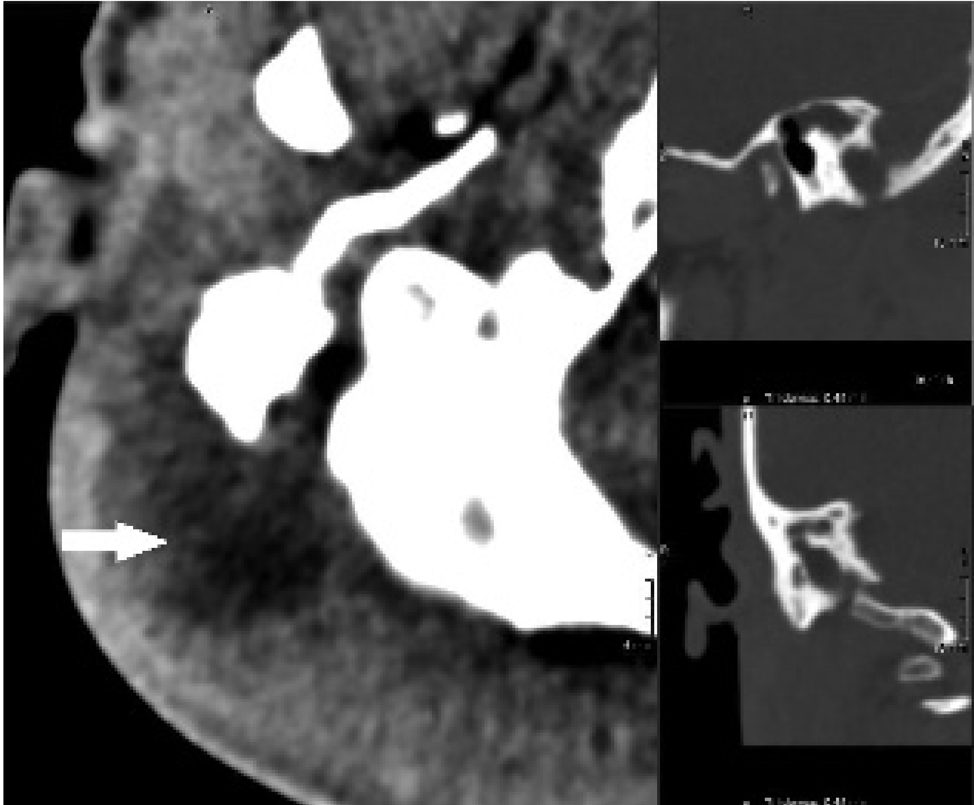 HRCT Temporal Bone - Mastoiditis with Bezold abscess