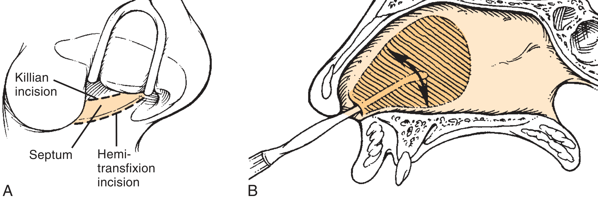 Killian incision and hemitransfixion incision, with Cottle elevator flap elevation - Cummings Otolaryngology