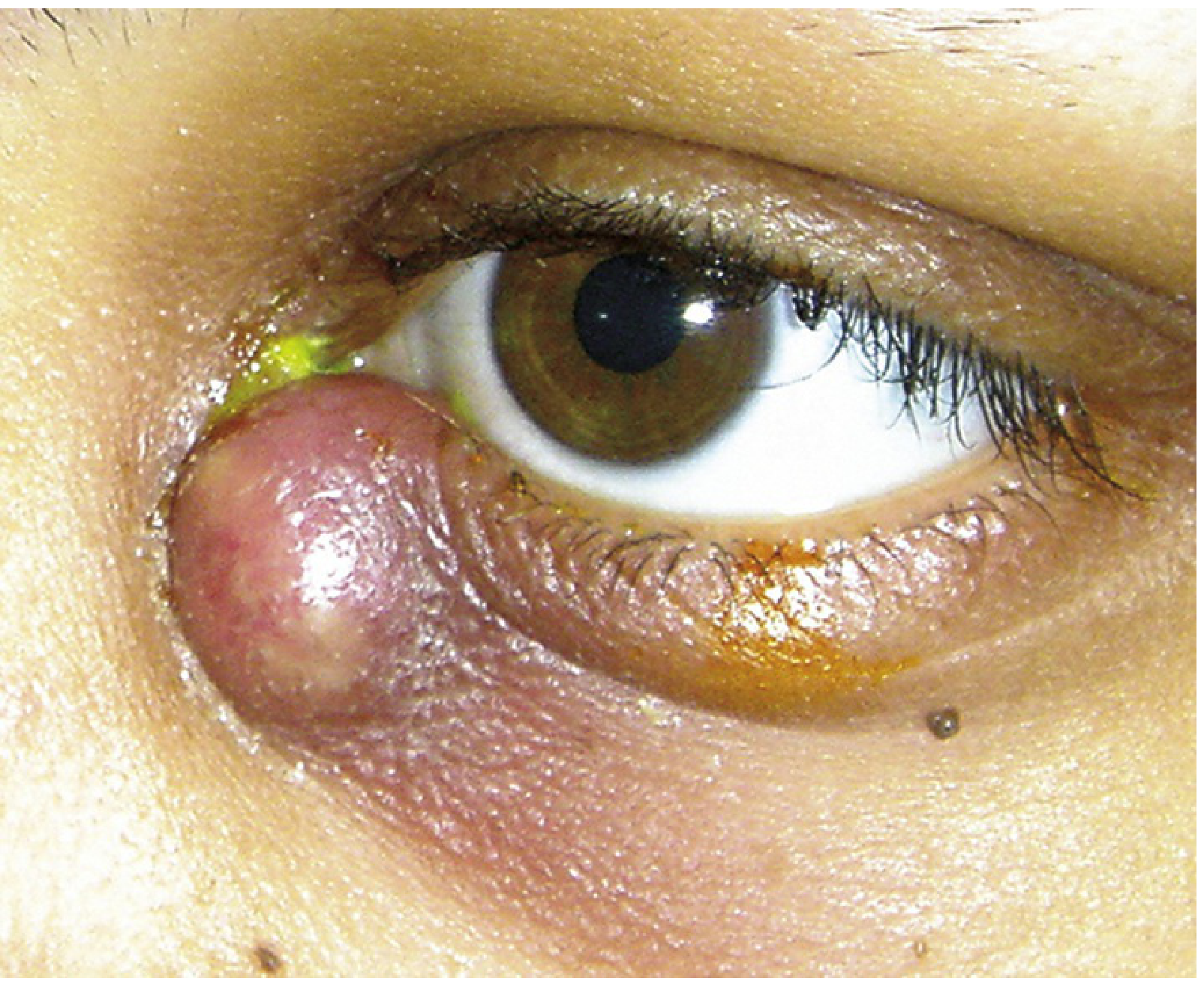 Acute dacryocystitis - erythematous, tense swelling at the medial canthus with purulent discharge