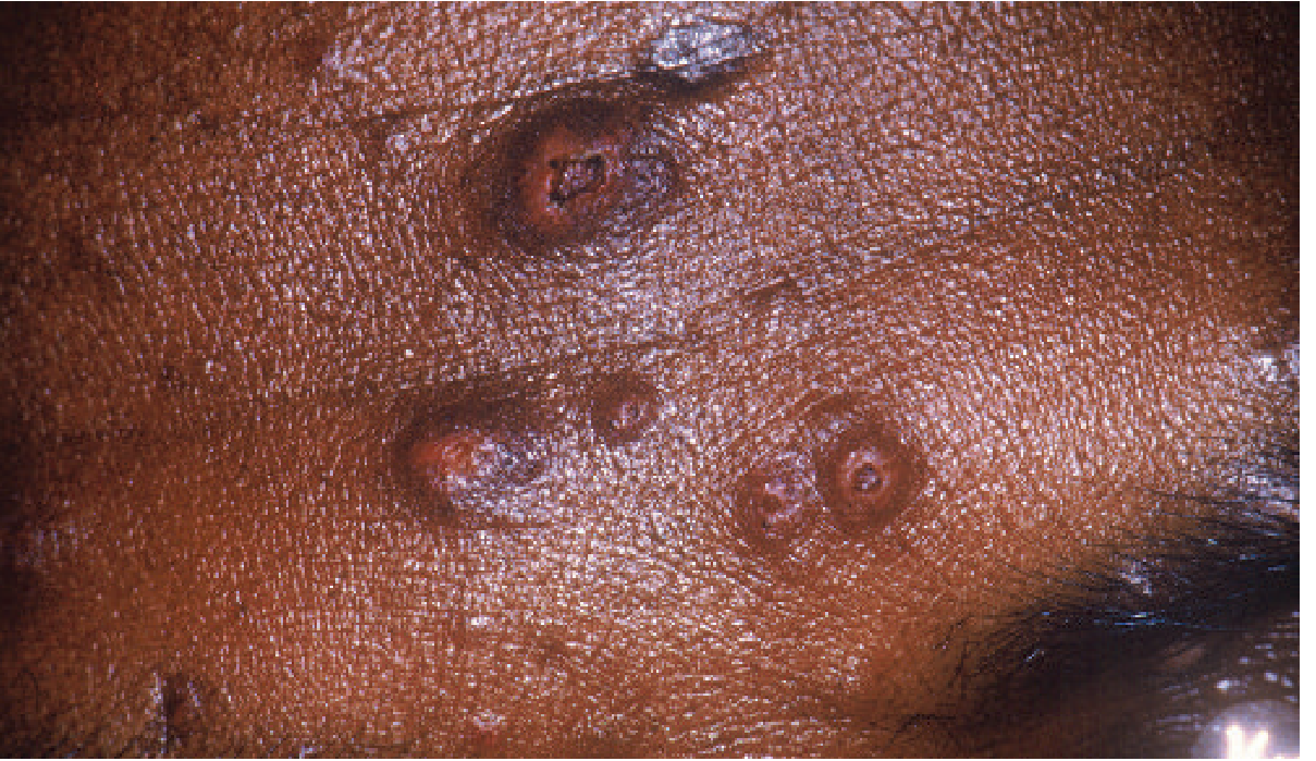 Cutaneous papules showing central necrosis in a patient with disseminated Talaromyces marneffei infection