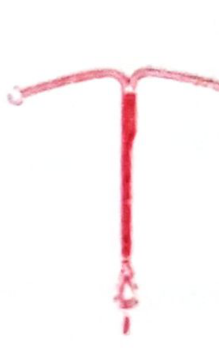 IUD types