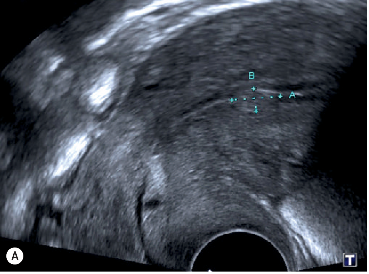Transvaginal ultrasound showing an endometrial polyp as focal endometrial thickening, measured by calipers