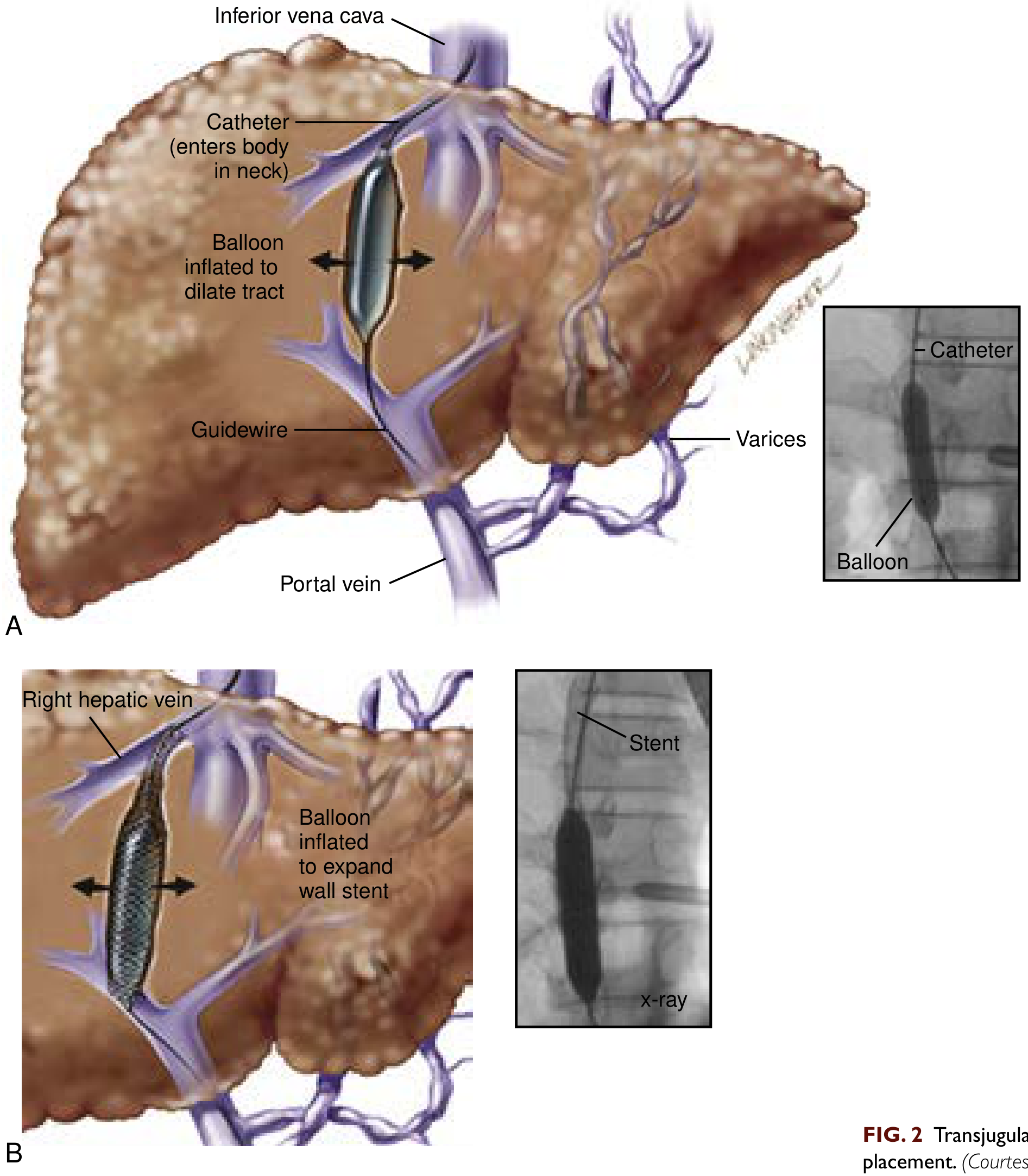 TIPS placement procedure - catheter entering via neck, balloon dilation of tract, and final stent placement