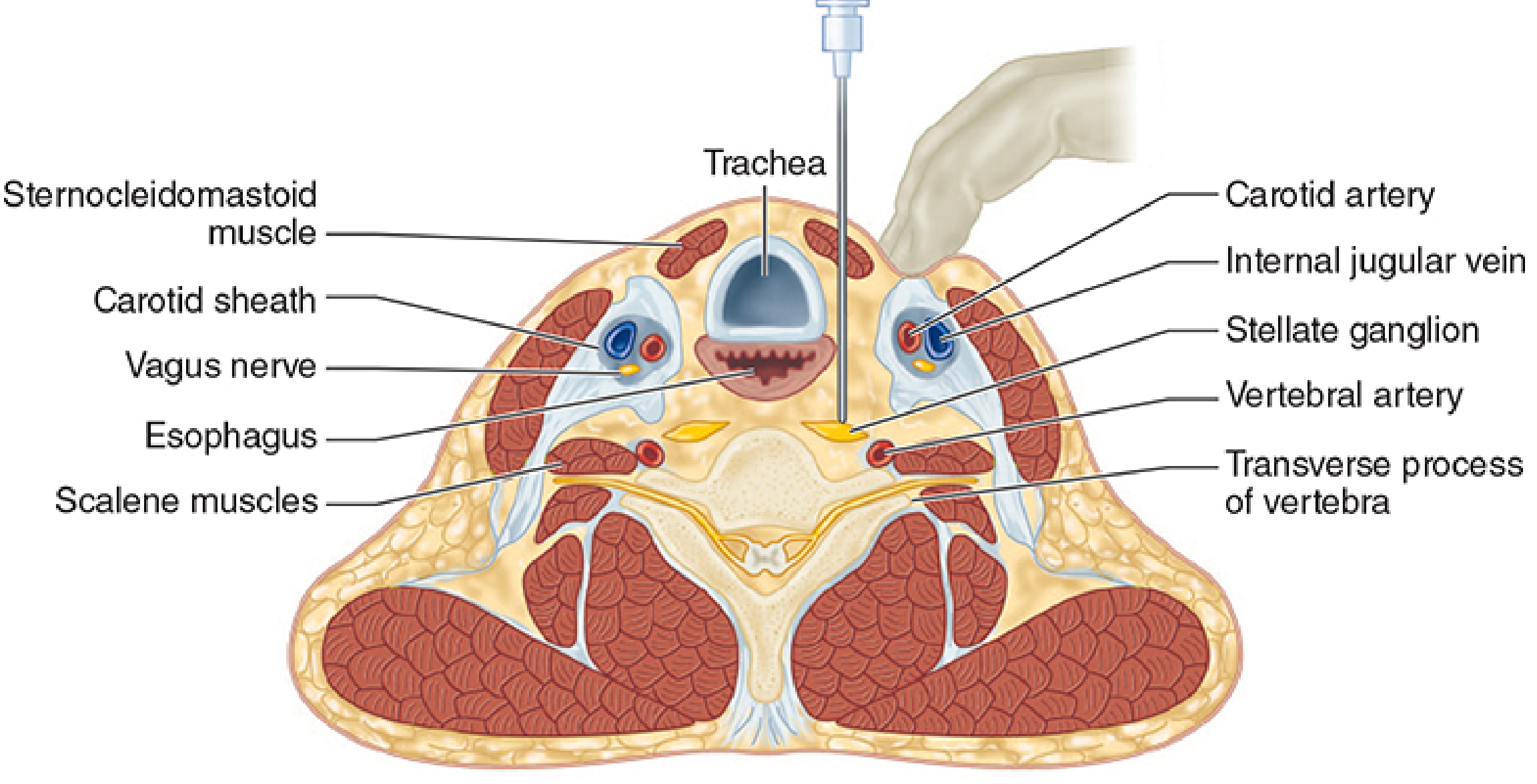 Cross-sectional neck anatomy showing stellate ganglion location relative to trachea, carotid artery, vertebral artery, scalene muscles, and needle trajectory for stellate block