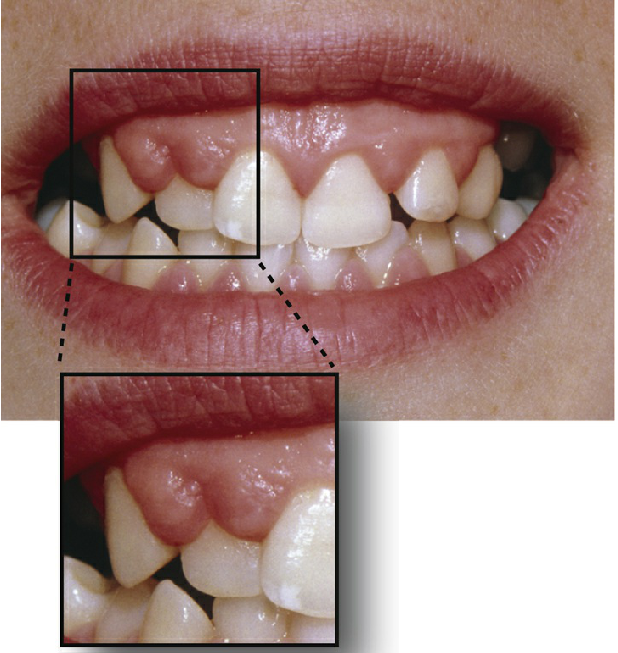 Gingival hyperplasia in a patient on phenytoin