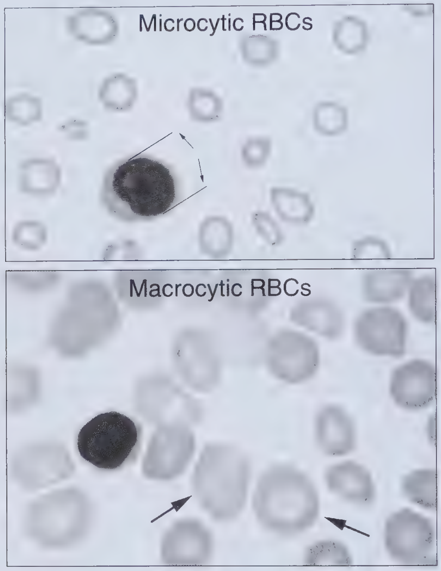 Microcytic and macrocytic RBCs on peripheral smear