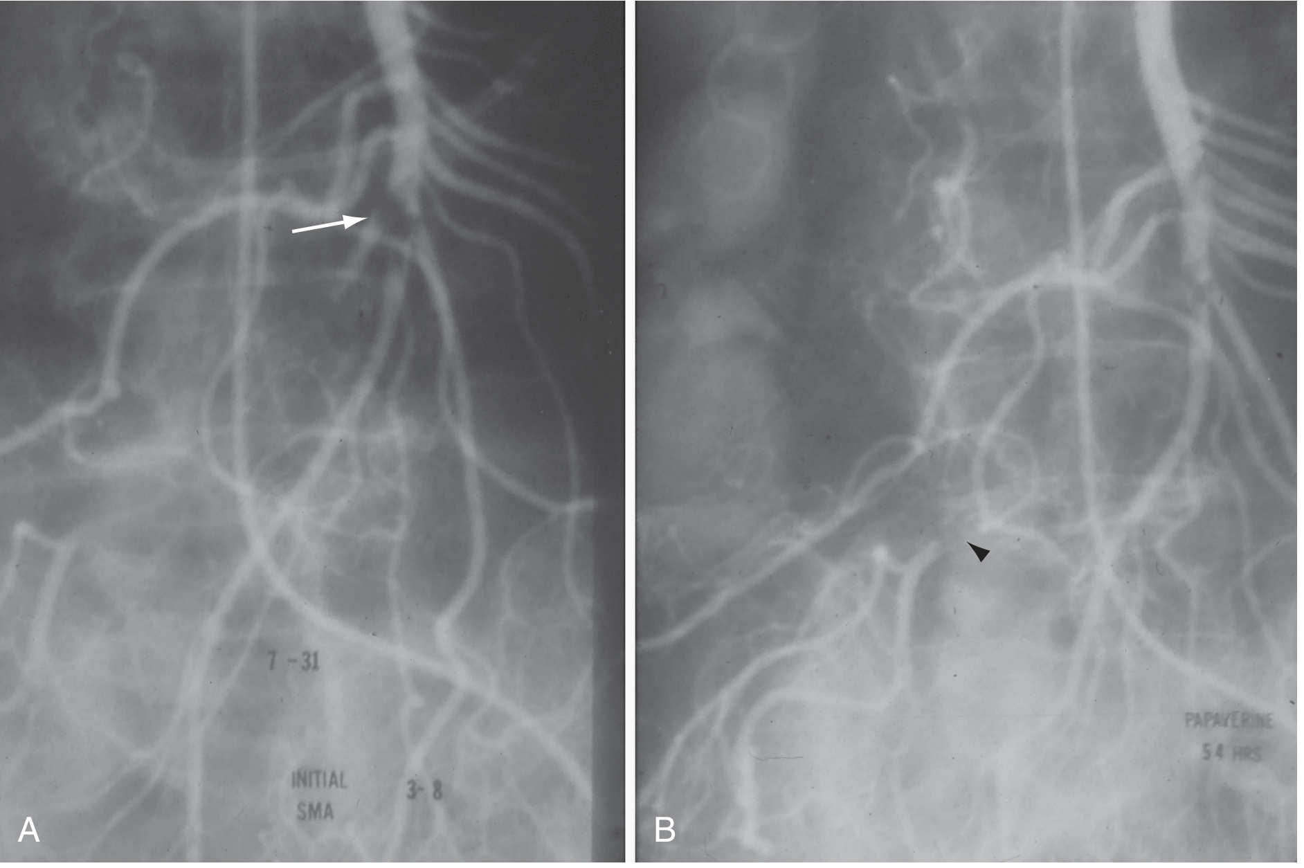 Fig. 118.8 — SMA angiogram embolus