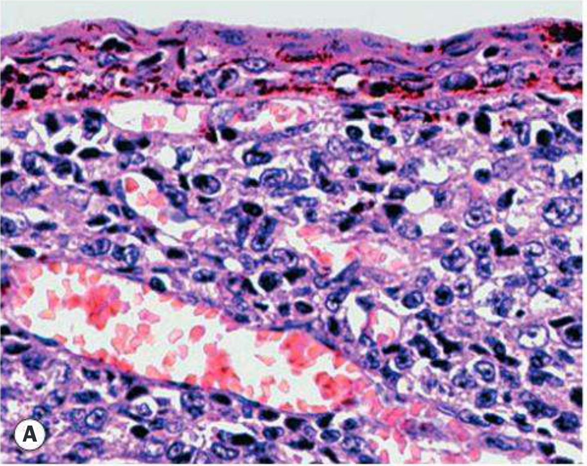 OSSN histology - carcinoma in situ showing full-thickness epithelial dysplasia