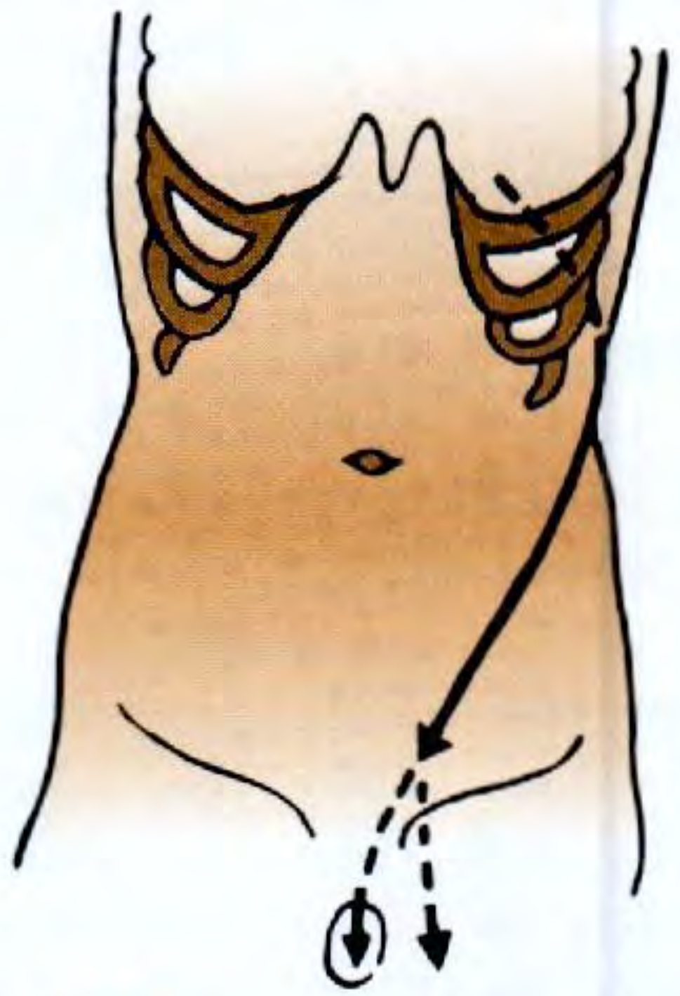 Radiation of pain in ureteric colic - from flank to groin and testis