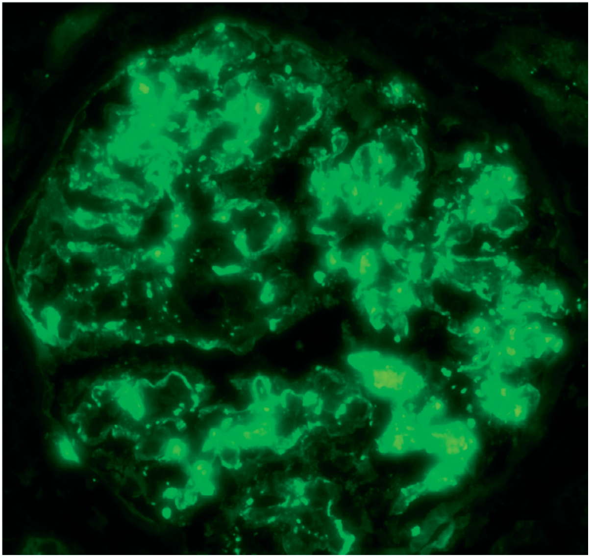 Coarse granular C3 staining in poststreptococcal GN - compare with the fine granular pattern of membranous nephropathy
