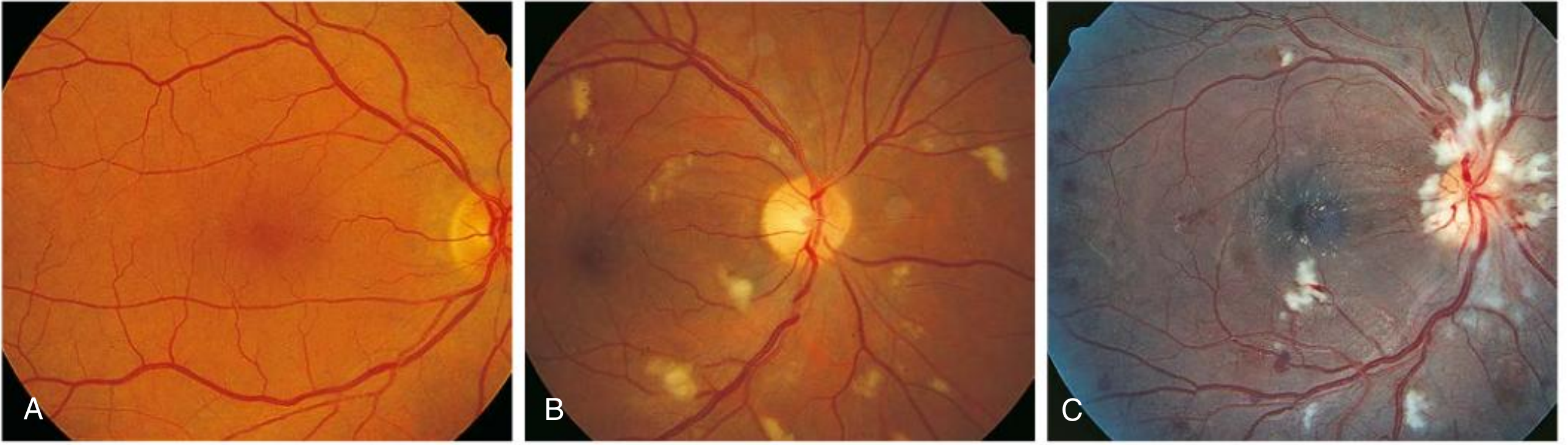 Grades of Hypertensive Retinopathy - A: Normal/Mild (arteriolar narrowing), B: Moderate (cotton-wool spots), C: Severe (papilledema, hemorrhages, macular star)