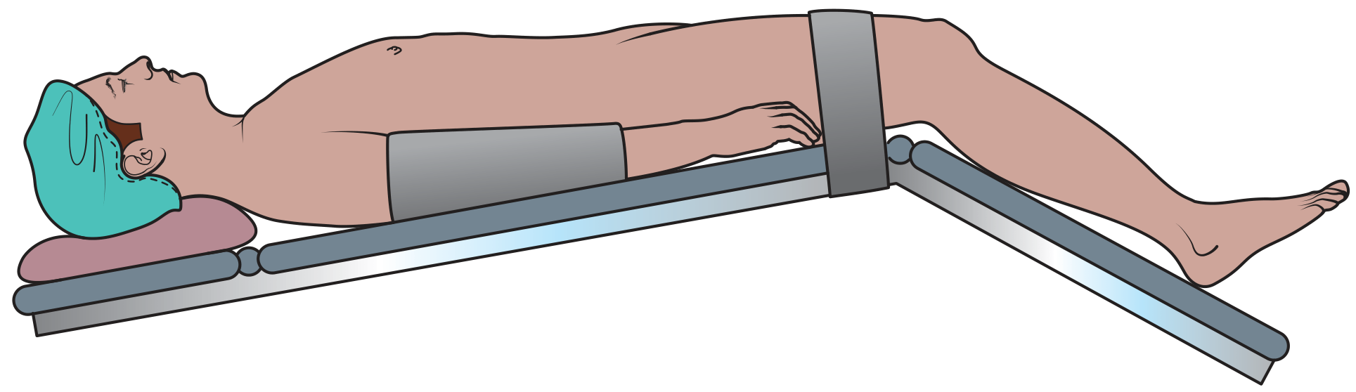 Trendelenburg position - patient supine on operation table with safety belt above the knee and head-down tilt