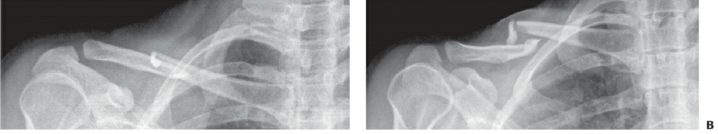 Figure 34-11: A - Standard AP radiograph of clavicle fracture; B - Same fracture in 30-degree cephalad tilted view showing better displacement