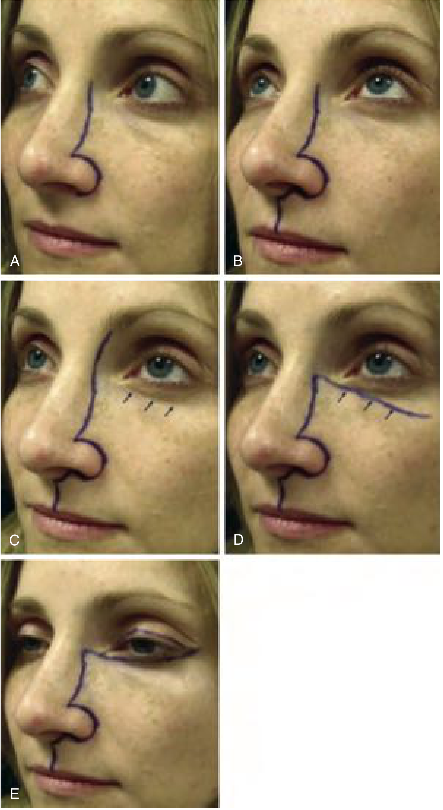 Modified surgical incisions for access to tumors of the nasal cavity and paranasal sinuses - showing lateral rhinotomy (A), modified Weber-Ferguson (B, C), and Lynch extension variants (D, E)